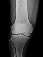 Osteoarthritis knee . film x-ray AP