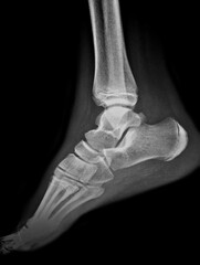 Film x-ray both foot bone