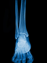 Pain foot X-ray of foot Arthritis of ankle