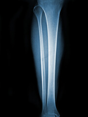 X-ray normal human tibia Lateral view