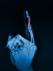 closed fracture finger distal phalanx