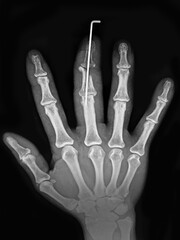 x ray of human hand