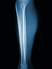 X-ray normal human tibia Lateral view