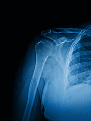 X-Ray Image Of Human Chest for a medical diagnosis