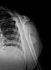 film x-ray fracture at neck of hummers ( arm bone )