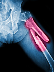 Film X-ray femur show complete fracture shaft of femur and displace
