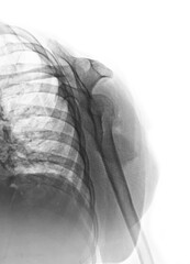film x-ray fracture at neck of humerus ( arm bone )