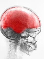 "Stroke" X-ray Asian skull (Thai people) and headache