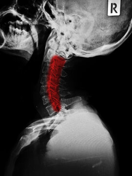 film x-ray skull lateral view and neck pain