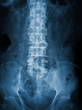 X-ray abdomen supine position image