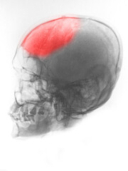 X-ray of foot pain of patient with red color at head
