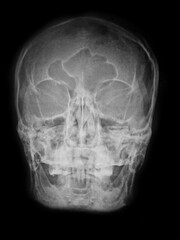 x ray image of skull