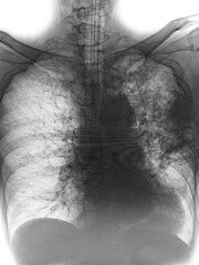 "Pulmonary tuberculosis" Film chest x-ray show interstitial infiltration both lung