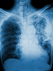 "Pulmonary tuberculosis" Film chest x-ray show interstitial infiltration both lung