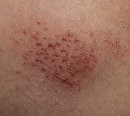 Fototapeta premium scratches on the skin as a background
