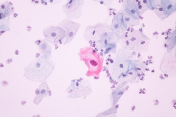 Abnormal squamous epithelial cells view in microscopy.HPV criteria for pap smear slide cytology.Koilocyte cells.Human cell medical concept background.
