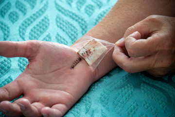 A female nurse removes a padded bandage on the wrist and hand of a woman. The palm has a number of...