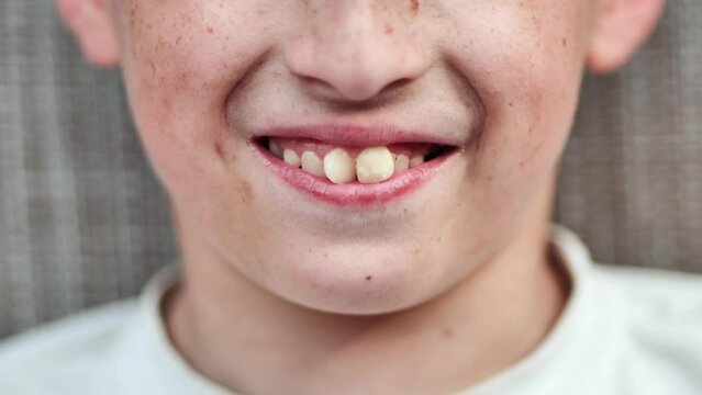 The boy's front crooked teeth.