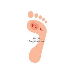 Foot with fungal skin disease