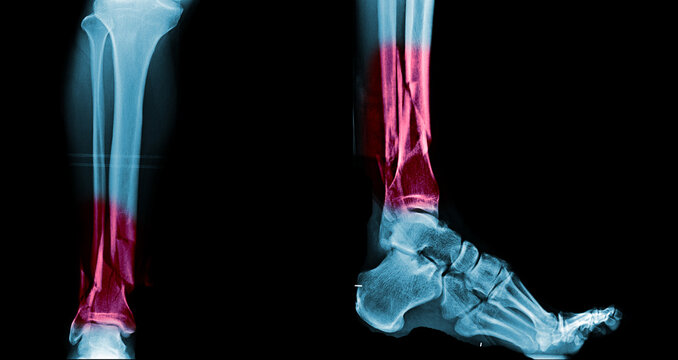 x-ray image of fracture leg bone in red area.