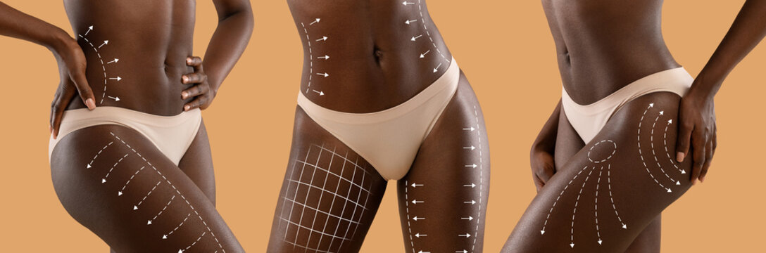 Millennial black women in bikini with perfect skin with lines for body shaping or drainage massage