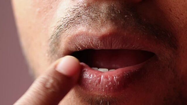 Dry lips problem