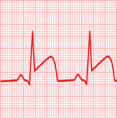 depicts ECGs for myocardial infarction. Heart attack sign. coronary artery thrombosis symbol. flat style.