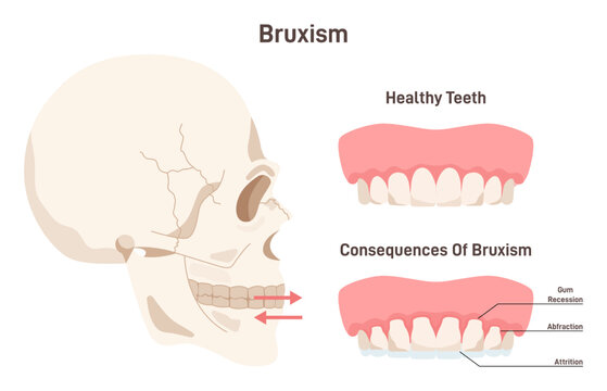 Bruxism. Condition in which person grind, gnash or clench your teeth.