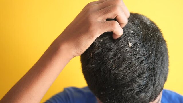 men with dandruff in his hair, closeup 