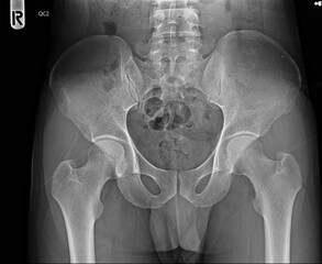x ray of a pelvic