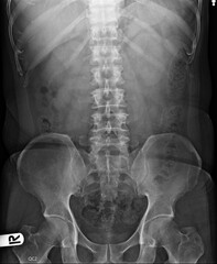 Film x-ray show abdomen disease