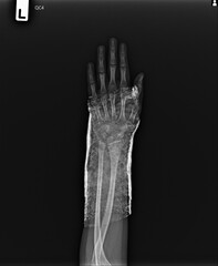 Film x-ray AP Forearm on Slap
