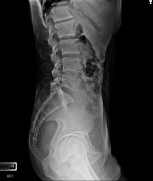 x ray of a L-spine