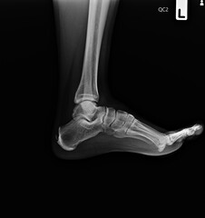 Film x-ray of  ankle . Lateral view