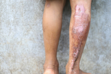 close up of fire burn wound on leg from hard accident in daily life activity. soft focus.