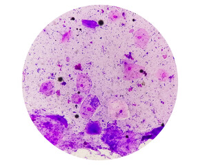 Gram stain of High vaginal swab, photomicrograph.