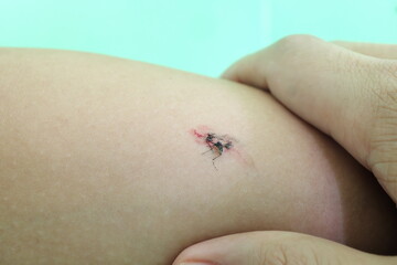 Selective focus of a crushed or smashed mosquito on arm with blood.