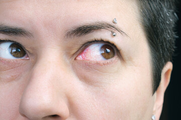 Close-up of an eye infected with conjunctivitis. Eyeball reddened from infection