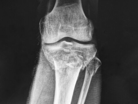 X-ray image of tibial plateau fracture and fibular head fracture