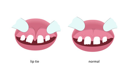 Lip tie illustration before and after surgery.