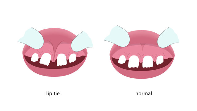 labial frenulum normal