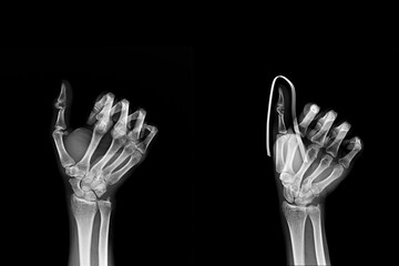 X-ray multiple film x-ray fracture finger and aluminum splint