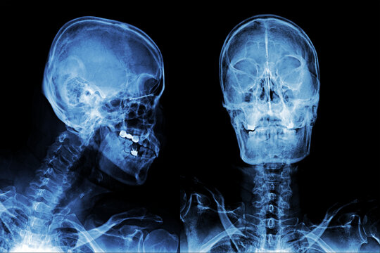 X-ray AP and lateral, X-ray image of skull frontal and side view