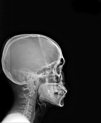 x ray of human skull