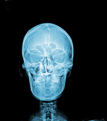 x ray of human skull