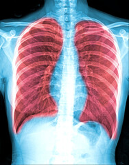 Pneumonia ( film chest x-ray show alveolar infiltrate at right middle lung ) ( image for pulmonary tuberculosis . Mers-CoV . SARS )