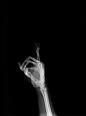 film X-ray fracture finger