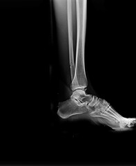 Naklejka premium Film x-ray of facture ankle . Lateral view 