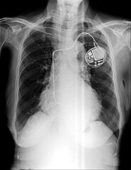 Film chest x-ray show pacemaker implantation in red area