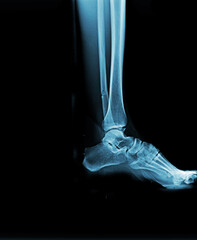 Film x-ray of facture ankle